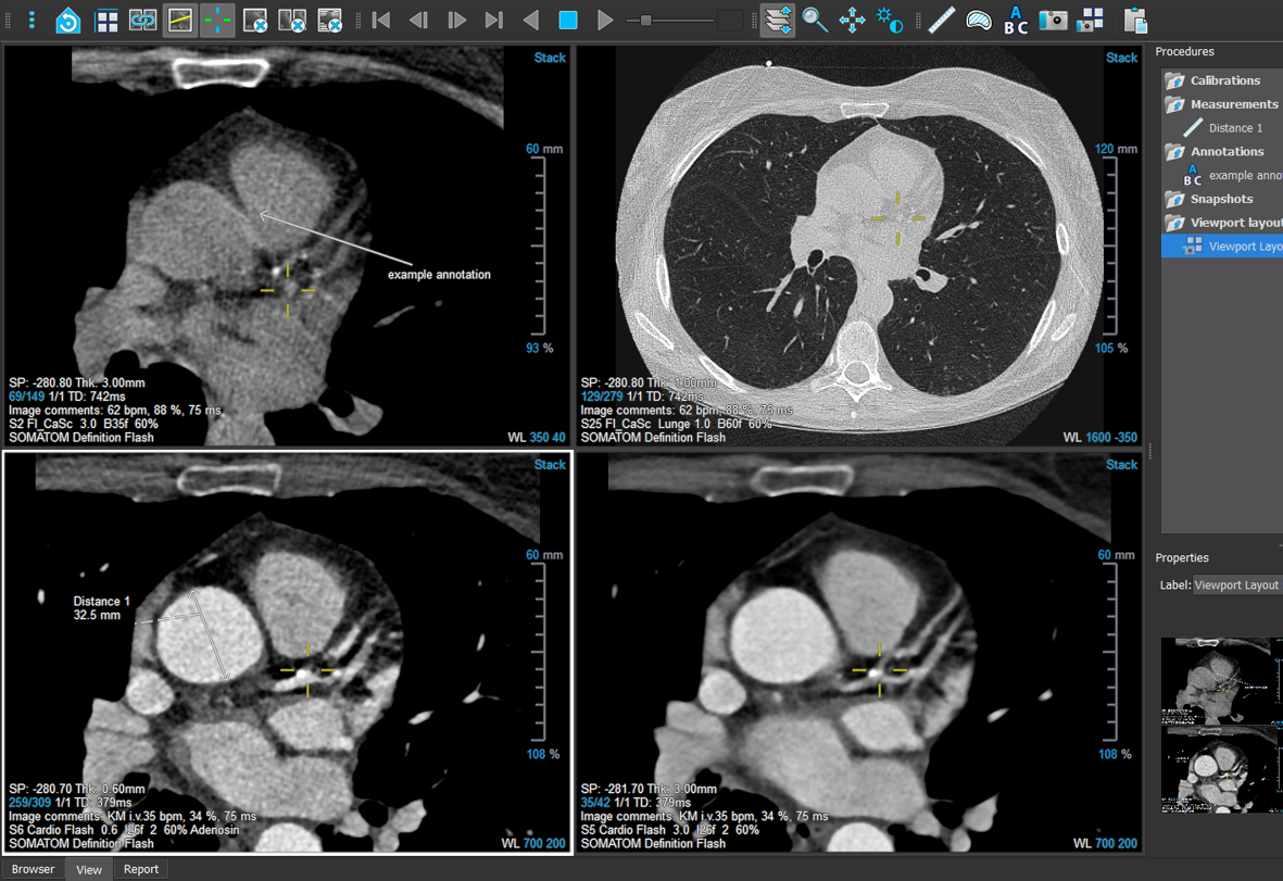 Medis Suite CT Viewer