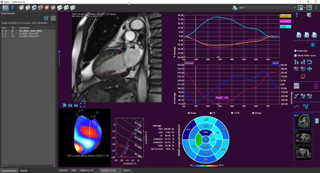 LV Strain - medisimaging