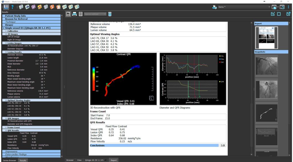Medis Suite XA Report Medis Medical Imaging