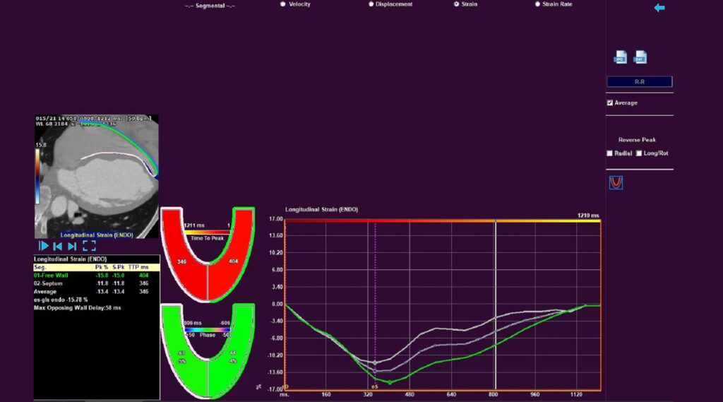 RVStrainsegmentalbig medisimaging