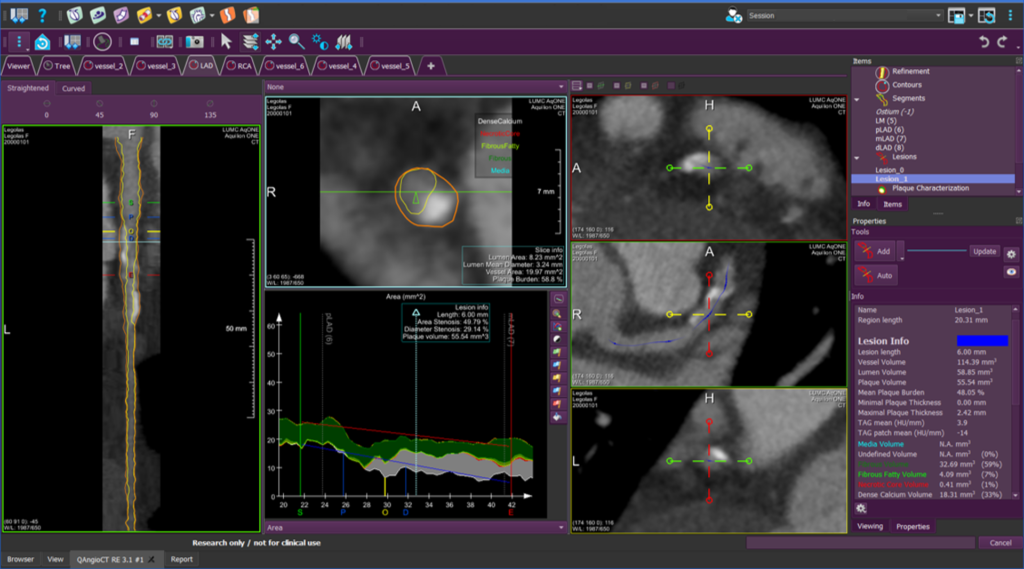 Medis Suite CT – Plaque analysis