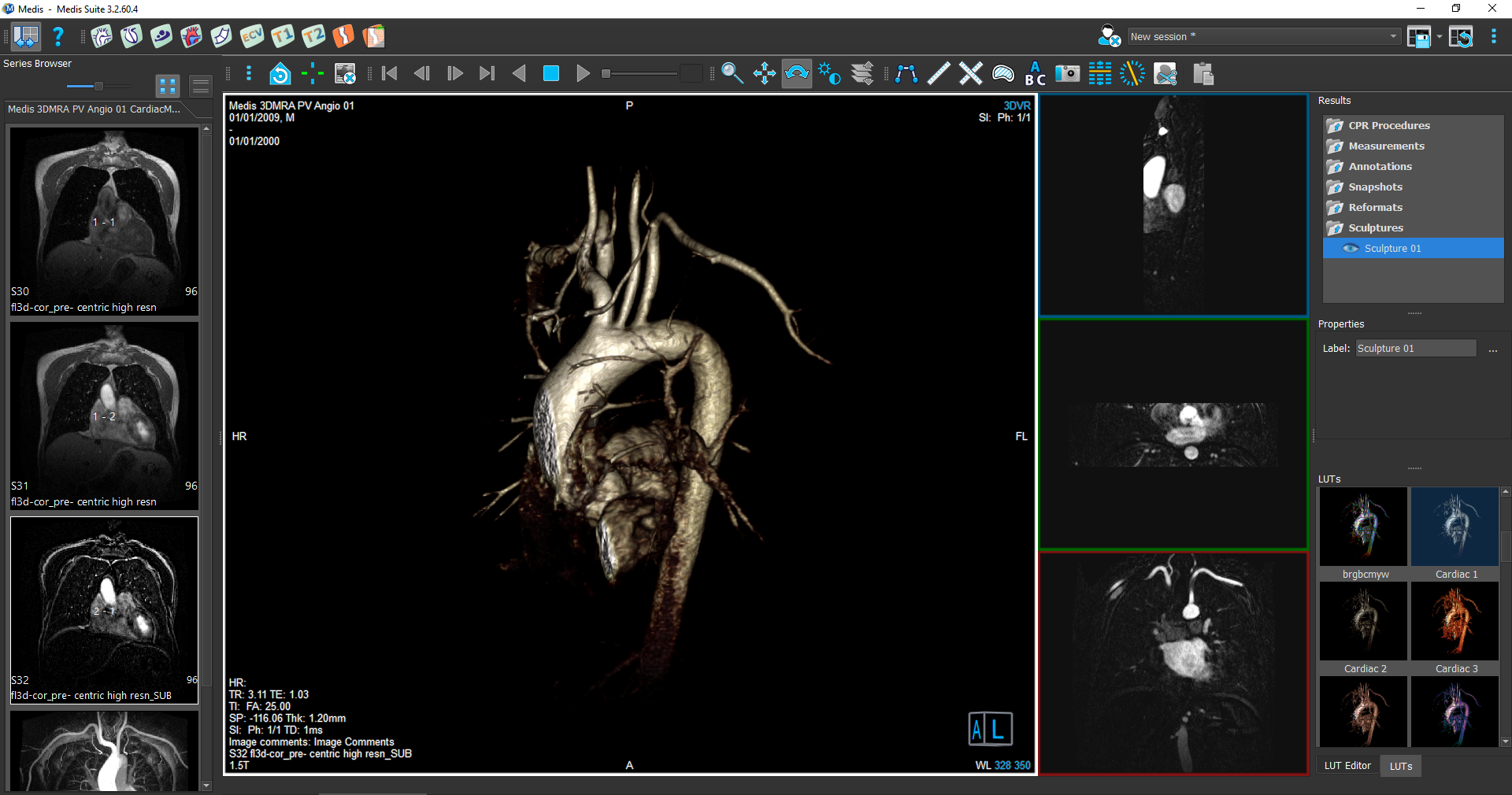 Medis Suite MR 3D Viewer Module 3 (current1becomes4)