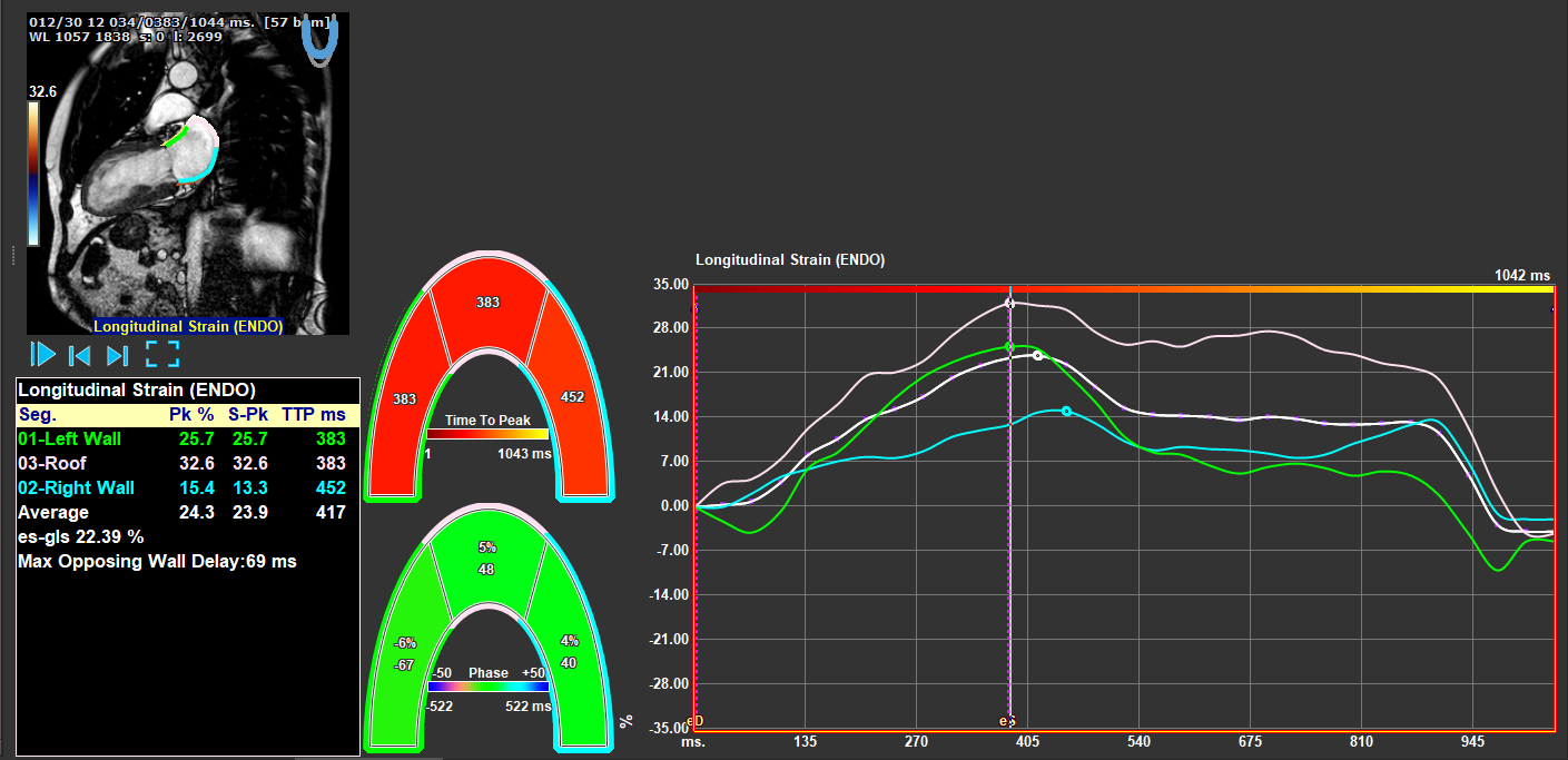 Atrial Strain_Module2
