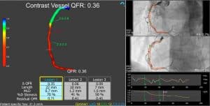 Contrast Vessel QFR 0.36 Case-1-2