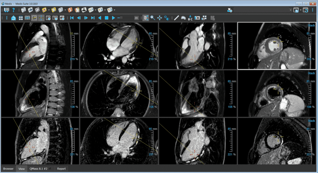 Cardiac MRI Medis Suite MR viewer