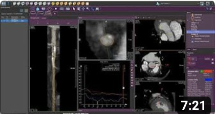 Motion - Inward Displacement - Metrics of the Heart - medisimaging