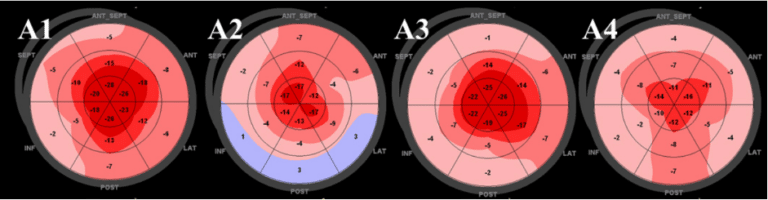 Motion - Inward Displacement - Metrics of the Heart - medisimaging