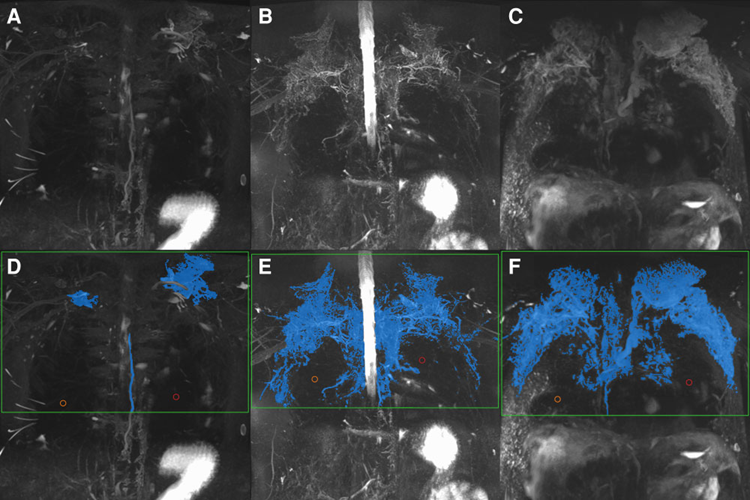 Figure 1: Lymphatic segmentation of T2MRL to quantify lymphatic burden in three representative patients. Images A, B, C show the T2MRL images of the three patients and D, E, F show the corresponding segmentation to provide a surrogate measurement of lymphatic volume, which is indexed to body surface area to quantify lymphatic burden in mL/m2. Latest Developments of Medis Suite MR and CT image of the research by Dr. Vaikom