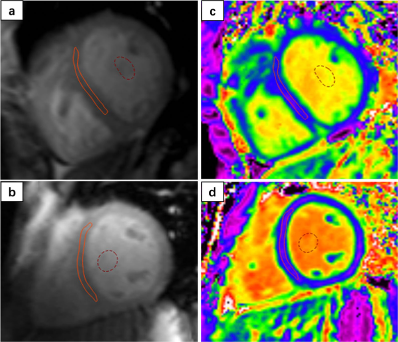 Figure 3: Native T1 (a, b) and ECV Mapping (c, d) images of a normal control (a, c) and a patient with Eisenmenger syndrome (b, d). Latest Developments of Medis Suite MR and CT image of the research by Dr. Gong