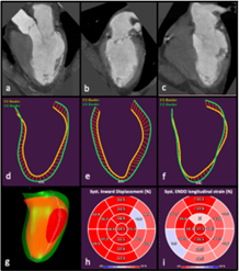 Inward displacement in CT. Measuring cardiac function using Medis