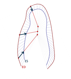 Inward Displacement. Measuring cardiac function using Medis