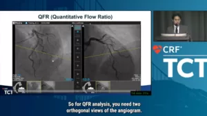 The impact of Medis QFR® on clinical decision-making