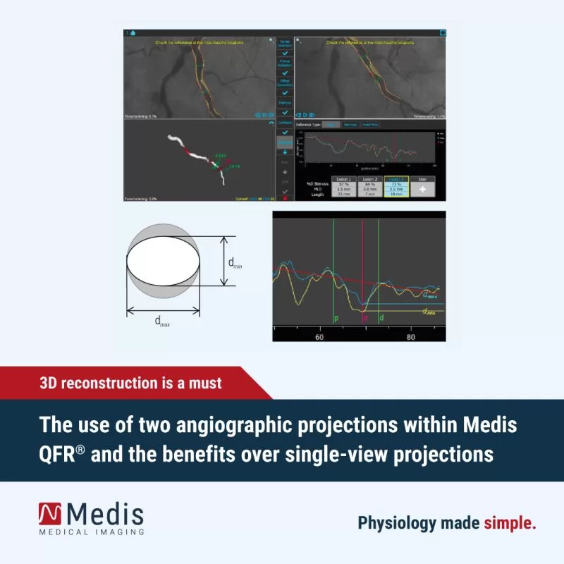 The use of two angiographic projections within Medis QFR® and the benefits over single-view projections.